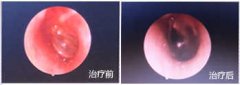 耳朵一直有脓液 怎么快点干耳