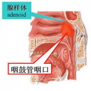 腺样体肥大的检查以及诊断
