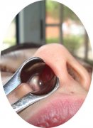 鼻息肉不及时治疗的后果有多恐怖,自己看图!