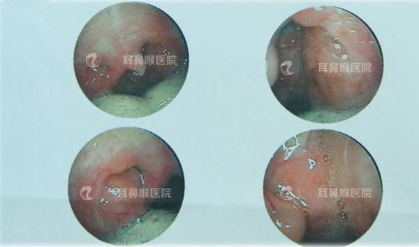 腺样体肥大合并慢性扁桃体炎患儿实施手术