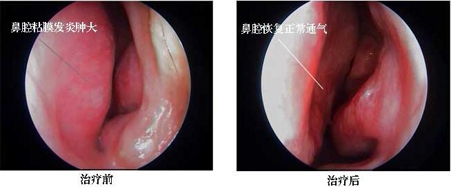 过敏性鼻炎治疗前后对比