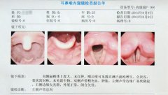 声音嘶哑持续三年 经治疗终