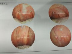 嗓子痒老咳嗽,南京哪家医院看咽炎好