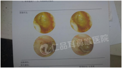 到医院看个耳朵大概多少钱