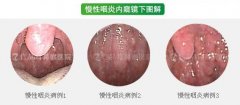 喉咙有异物感挂哪个科