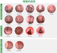 慢性咽炎做什么手术能根除