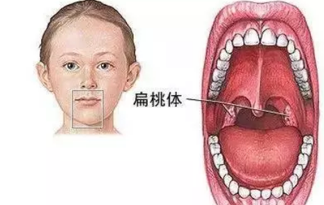 鼻咽部腺样体肥大图片图片
