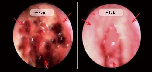 南京医院治疗咽炎的方法