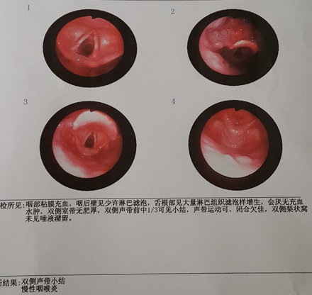 声带小结是怎么引起的