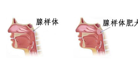 得了腺样体肥大要怎么治疗?