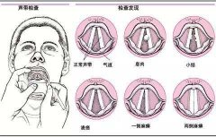 预防声带小结及时戒烟酒