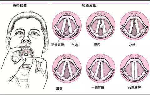 预防声带小结及时戒烟酒